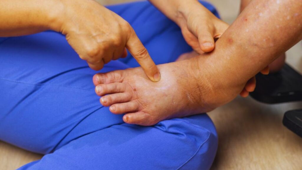 A lymphedema therapist dressed in blue scrubs gently examines and presses on a swollen patient’s lower leg and foot, demonstrating a hands-on assessment for swelling and discomfort.