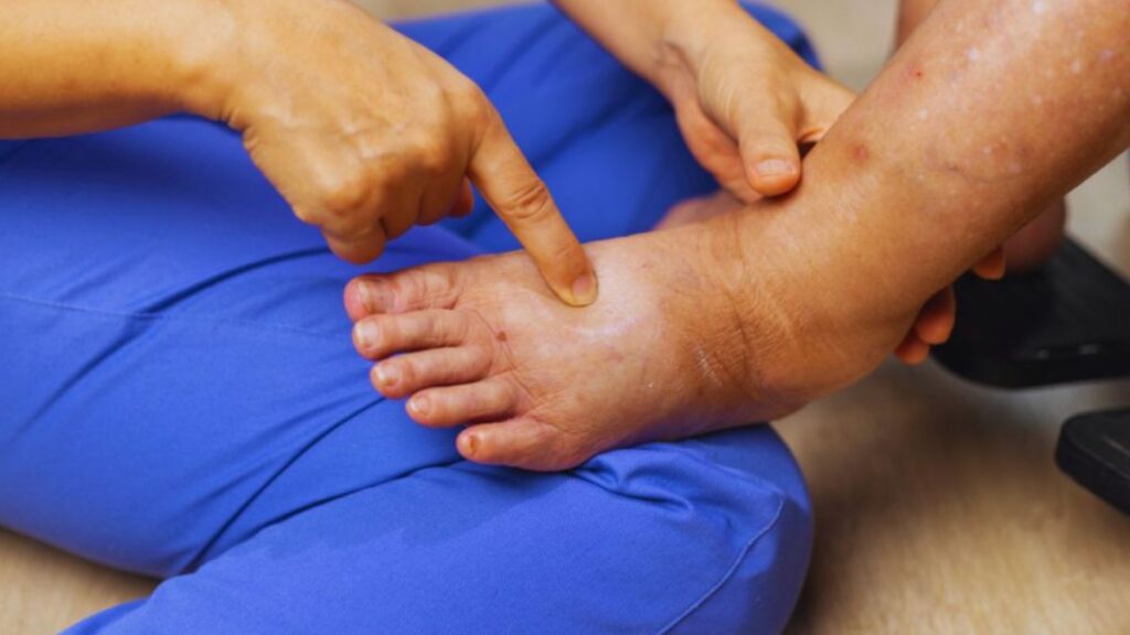 A therapist in blue scrubs lightly stretches the skin of a swollen foot and ankle using gentle manual lymphatic drainage (MLD) techniques.