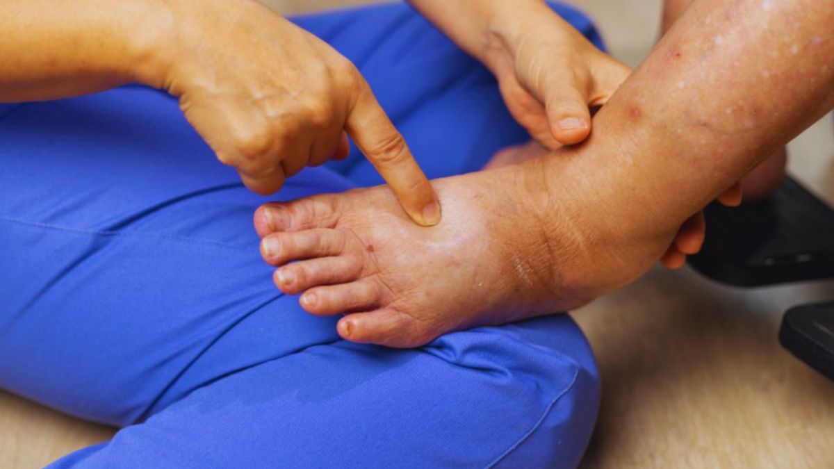 A therapist in blue scrubs lightly stretches the skin of a swollen foot and ankle using gentle manual lymphatic drainage (MLD) techniques.